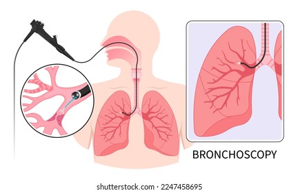 Chronic asthma test medical chest X RAY for Bronchioles tumor cancer malignant cell surgical with flexible fiber optic guided lymph node masses mucus plug bronchi washing