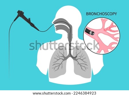 Chronic asthma test medical chest X RAY for Bronchioles tumor cancer malignant cell surgical with flexible fiber optic guided lymph node masses mucus plug bronchi washing