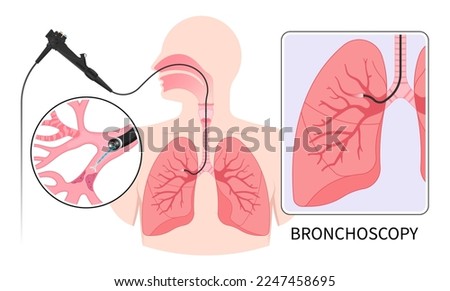 Chronic asthma test medical chest X RAY for Bronchioles tumor cancer malignant cell surgical with flexible fiber optic guided lymph node masses mucus plug bronchi washing