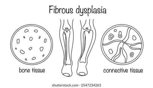 Uma doença óssea crônica na qual o tecido ósseo normal é substituído pelo tecido conjuntivo. Deformação dos ossos da perna devido a displasia fibrosa. Linha desenhada perna saudável e doente.