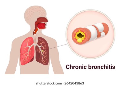 Chronic bronchitis. Lung diseases anatomy. Human respiratory system.