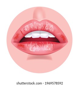Chronic cheilitis. Dry chapped lips. Ripped skin. Disease of the mouth. Flaking skin flakes. Vector illustration