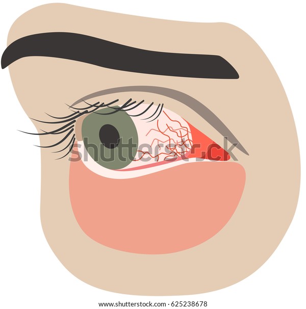 Chronic Conjunctivitis Eye Red Iris Pus เวกเตอร์สต็อก ปลอดค่าลิขสิทธิ์ 625238678 Shutterstock 