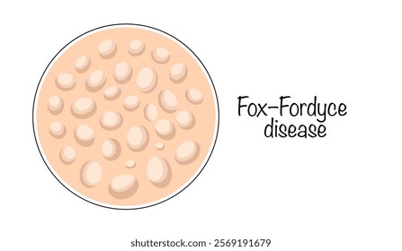 A chronic disease of the apocrine glands, manifested by the appearance of itchy skin rashes. Vector illustration with the manifestation of the disease on the skin. Fox–Fordyce disease.