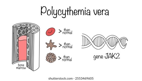 A chronic disease characterized by excessive production of red blood cells, platelets and white blood cells in the bone marrow. This condition is associated with a mutation in the JAK2 gene. Vector.