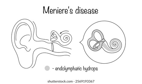 A chronic disease of the inner ear, which is characterized by dysfunction of the vestibular apparatus and hearing due to excessive accumulation of endolymph in the inner ear. Vector illustration.