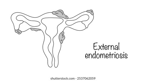 Uma doença crônica em que células semelhantes às chamadas células endometriais estão localizadas fora do útero. Órgãos genitais femininos com endomitriose externa. Ilustração vetorial.