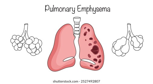 Doença crônica em que há uma expansão irreversível do ar, acompanhada de alterações destrutivas nos alvéolos. Pulmões e pulmões saudáveis com enfisema e lesão alveolar.