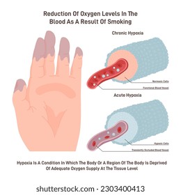 Hipoxia crónica. Efecto peligroso del tabaco en el suministro de oxígeno. Disminución de la circulación de oxígeno en sangre causando dedos azules y pulgares. Ilustración vectorial plana