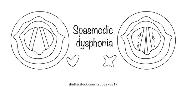 Chronic impairment of vocal function caused by spasms of the laryngeal muscles. These spasms interfere with the normal vibration of the vocal cords, resulting in a change in voice or loss of voice.