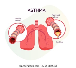 Chronic Inflammation, swelling, and increased mucus production in the bronchial airways - Stock Illustration as EPS 10 File