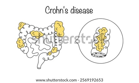 Chronic inflammatory bowel disease, in which fat is deposited on the intestinal walls and microcracks form. Medical illustration on a white background. Crohn's disease.