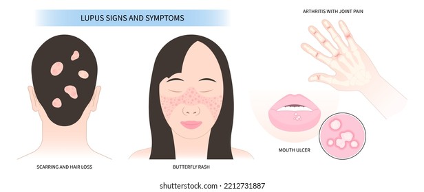 chronic inflammatory disease and joint facial Pain butterfly and malar rash hair loss kidney failure of Raynaud face purple or pale