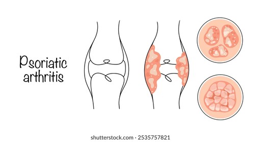 A chronic inflammatory disease of the joints that occurs against the background of psoriasis. Drawing of a healthy joint and a joint with psoriatic arthritis. Medical vector.