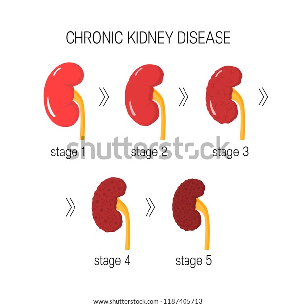 Chronic Kidney Disease Ckd Concept Vector Stock Vector (Royalty Free ...