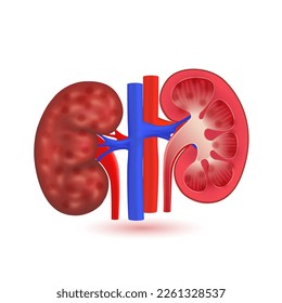 Chronic kidney disease, Human kidneys red model isolated on white background. Medical pharmaceutical and treatment concept. 3d realistic vector.