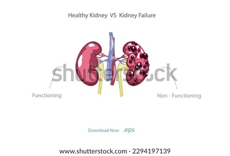 Chronic kidney failure, involves a gradual loss of kidney function. Your kidneys can't filter wastes and excess fluids from your blood. Vector illustration.