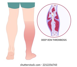 Chronic Leg Pain Varicose Veins Swelling Obesity Ankle Foot Diabetes Syndrome Blood Clot Disease