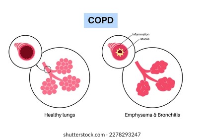Enfermedad pulmonar obstructiva crónica o EPOC. Grupo de enfermedad pulmonar. Problema con las vías respiratorias y los sacos de aire, moco en los pulmones, alveolos colapsados. Enfermedad del sistema respiratorio humano ilustración vectorial plana