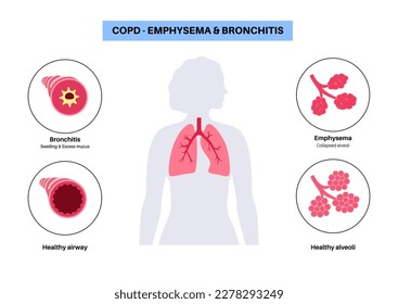 Chronic obstructive pulmonary disease or COPD. Group of lung disease. Problem with airways and air sacs, mucus in lungs, collapsed alveoli. Illness of human respiratory system flat vector illustration