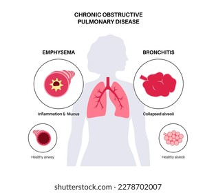 Chronic obstructive pulmonary disease or COPD. Group of lung disease. Problem with airways and air sacs, mucus in lungs, collapsed alveoli. Illness of human respiratory system flat vector illustration