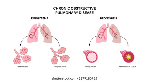 Chronic obstructive pulmonary disease or COPD. Group of lung disease. Problem with airways and air sacs, mucus in lungs, collapsed alveoli. Illness of human respiratory system flat vector illustration