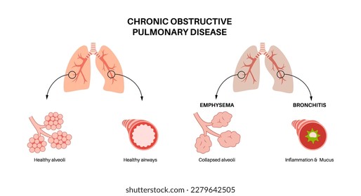 Enfermedad pulmonar obstructiva crónica o EPOC. Grupo de enfermedad pulmonar. Problema con las vías respiratorias y los sacos de aire, moco en los pulmones, alveolos colapsados. Enfermedad del sistema respiratorio humano ilustración vectorial plana