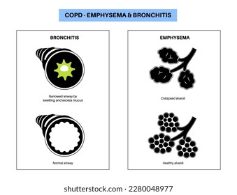 Chronic obstructive pulmonary disease or COPD. Group of lung disease. Problem with airways and air sacs, mucus in lungs, collapsed alveoli. Illness of human respiratory system flat vector illustration