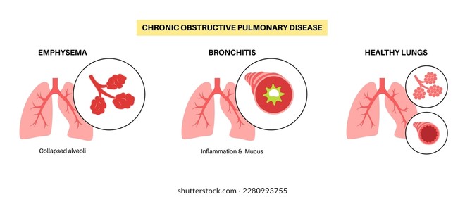 Chronische obstruktive Lungenerkrankung oder COPD. Gruppe von Lungenerkrankungen. Probleme mit Atemwegen und Luftsäcken, Schleim in der Lunge, kollabierte Alveoli. Erkrankung des menschlichen Atemsystems, flache Vektorgrafik