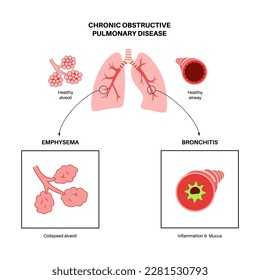 Chronische obstruktive Lungenerkrankung oder COPD. Gruppe von Lungenerkrankungen. Probleme mit Atemwegen und Luftsäcken, Schleim in der Lunge, kollabierte Alveoli. Erkrankung des menschlichen Atemsystems, flache Vektorgrafik