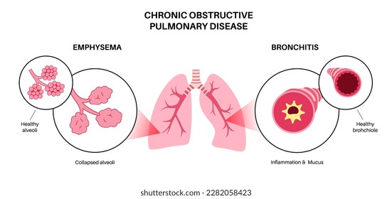 Chronic obstructive pulmonary disease or COPD. Group of lung disease. Problem with airways and air sacs, mucus in lungs, collapsed alveoli. Illness of human respiratory system flat vector illustration