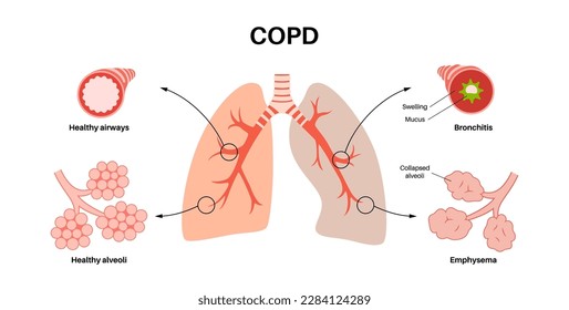 Chronic obstructive pulmonary disease or COPD. Group of lung disease. Problem with airways and air sacs, mucus in lungs, collapsed alveoli. Illness of human respiratory system flat vector illustration