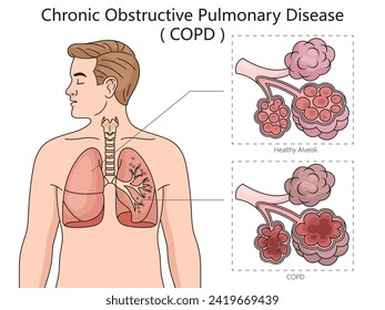 Chronic obstructive pulmonary disease COPD diagram hand drawn schematic vector illustration. Medical science educational illustration