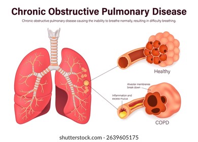 Chronic obstructive pulmonary disease (COPD). Comparison between normal bronchus and alveoli with bronchitis and emphysema. Human respiratory system.