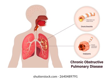 Chronic obstructive pulmonary disease (COPD). Chronic bronchitis and emphysema. Human respiratory system.