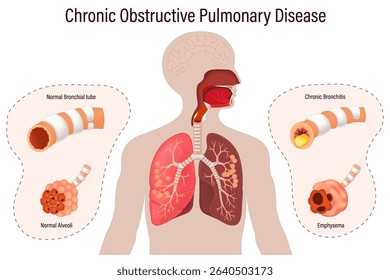 Chronic obstructive pulmonary disease (COPD). Comparison between normal bronchus and alveoli with bronchitis and emphysema. Human respiratory system.