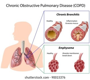 Chronic obstructive pulmonary disease (COPD)