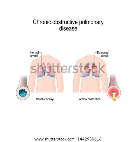 Chronic obstructive pulmonary disease (COPD). vector diagram for medical, educational and scientific use