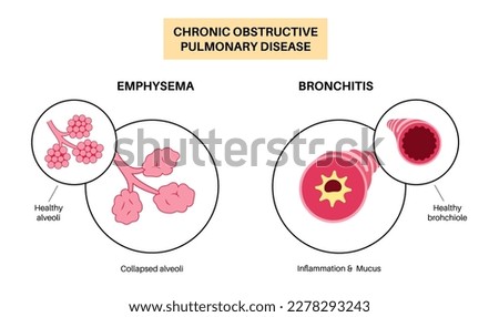 Chronic obstructive pulmonary disease or COPD. Group of lung disease. Problem with airways and air sacs, mucus in lungs, collapsed alveoli. Illness of human respiratory system flat vector illustration