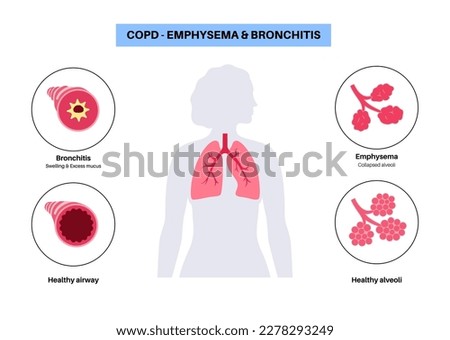 Chronic obstructive pulmonary disease or COPD. Group of lung disease. Problem with airways and air sacs, mucus in lungs, collapsed alveoli. Illness of human respiratory system flat vector illustration