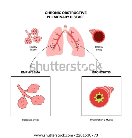 Chronic obstructive pulmonary disease or COPD. Group of lung disease. Problem with airways and air sacs, mucus in lungs, collapsed alveoli. Illness of human respiratory system flat vector illustration