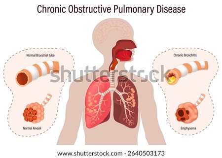 Chronic obstructive pulmonary disease (COPD). Comparison between normal bronchus and alveoli with bronchitis and emphysema. Human respiratory system.