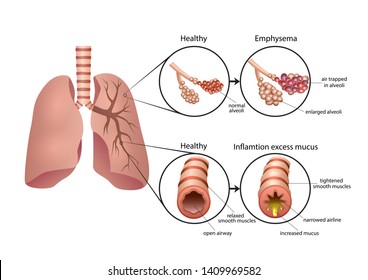 Chronic obstructive pulmonary disease Images, Stock Photos & Vectors ...