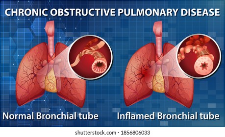 Chronic obstructive pulmonary disease illustration