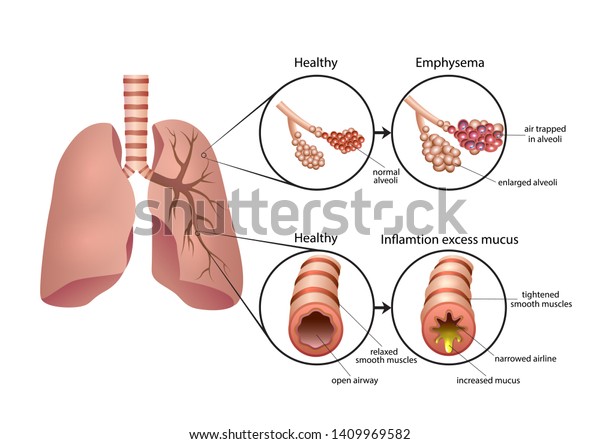 Chronic\
Obstructive Pulmonary Disease\
illustration