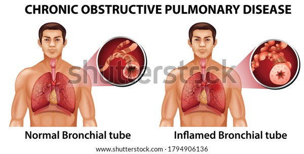 Chronic\
obstructive pulmonary disease\
illustration