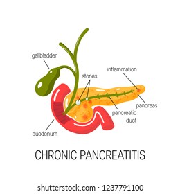 Chronic pancreatitis concept. Medical vector illustration of inflamed pancreas in cross section, duodenum and gallbladder