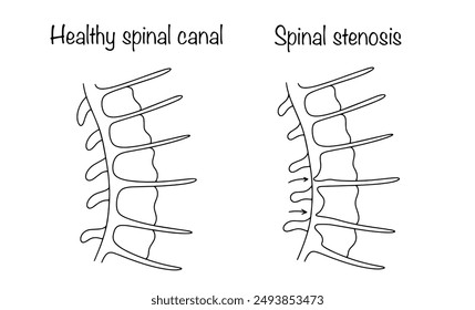 Una condición patológica crónica que consiste en estrechar el espacio dentro de la columna vertebral y la compresión de las estructuras anatómicas de la médula espinal y las raíces nerviosas. Columna vertebral sana y deformada.