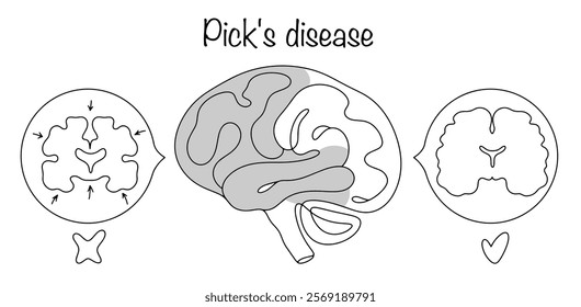 A chronic, progressive disease of the central nervous system, characterized by destruction and atrophy of the cerebral cortex in the frontal and temporal lobes. Hand drawn medical illustration.