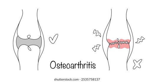 Chronisch fortschreitende Erkrankung, gekennzeichnet durch die allmähliche Zerstörung des Gelenkknorpels. Zeichnung eines gesunden Gelenks und eines Gelenks, in dem die Knochen aneinander reiben. Arthrose.